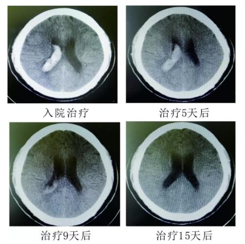 腦出血你不得不引起重視的疾?。。?！