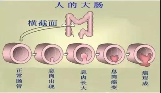 體檢發(fā)現(xiàn)腸息肉會癌變嗎？